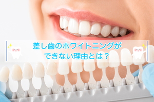 差し歯のホワイトニングができない理由とは?対処法と併せて解説