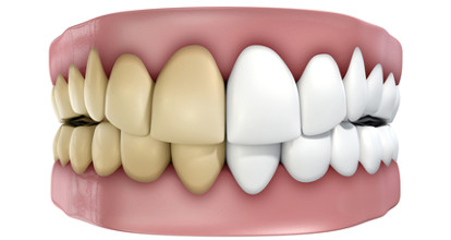 歯の黄ばみの治し方！歯を白くする方法を徹底解説
