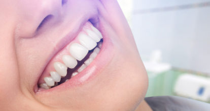 都城市　ホワイトニング