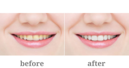 ホワイトニングのビフォーアフター